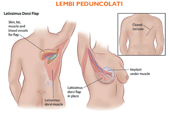 lembi peduncolati